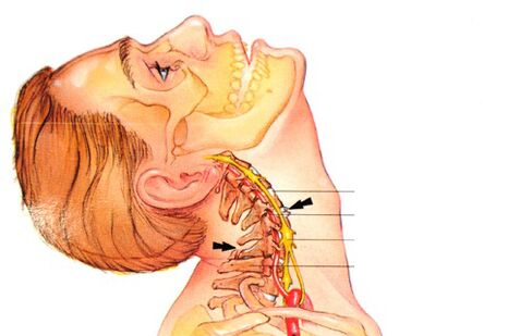 A nyaki gerinc osteochondrosis